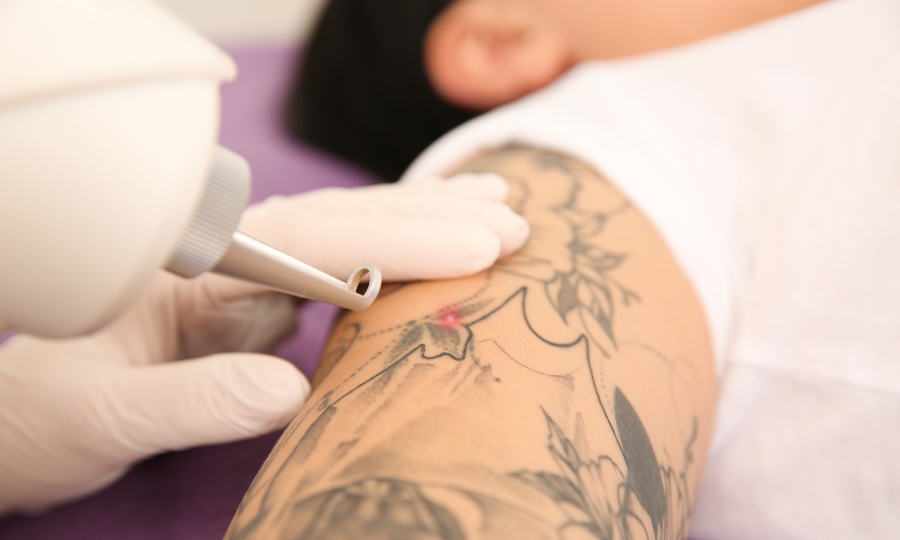 láser para eliminar tatuaje