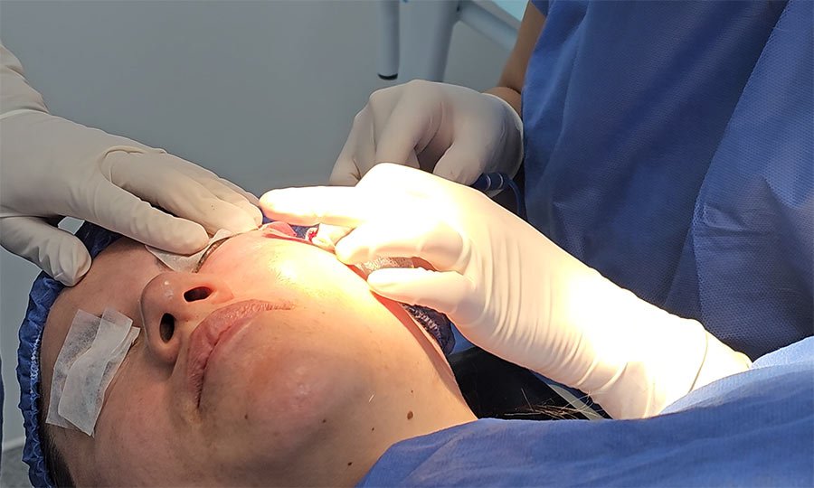 blefaroplastia laser bolsas ojos