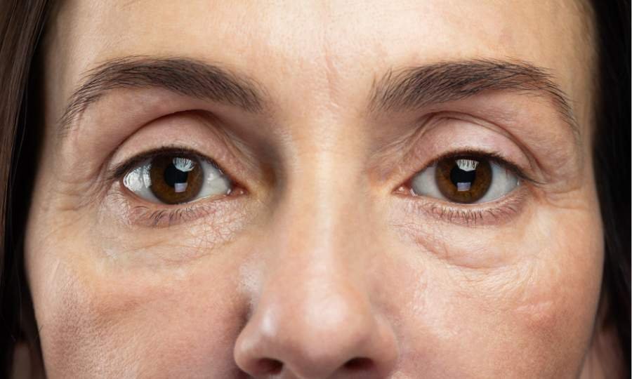 blefaroplastia laser ojeras bolsas